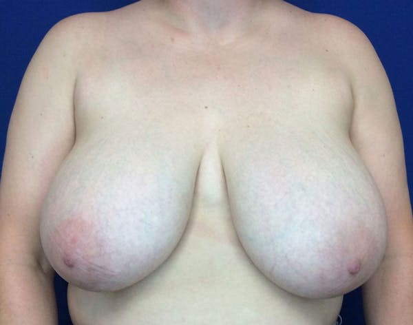 Breast Reduction Before & After Gallery - Patient 6388683 - Image 1