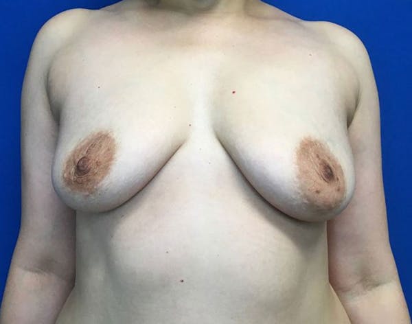 Breast Augmentation Before & After Gallery - Patient 6388717 - Image 1