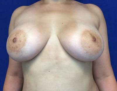 Breast Augmentation Before & After Gallery - Patient 6388717 - Image 2