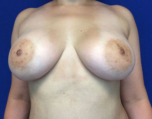 Breast Augmentation Before & After Gallery - Patient 6388717 - Image 2