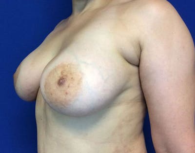 Breast Augmentation Before & After Gallery - Patient 6388717 - Image 4