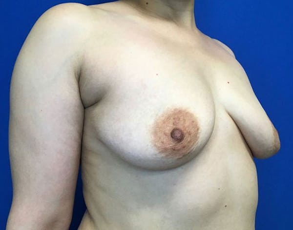 Breast Augmentation Before & After Gallery - Patient 6388717 - Image 5