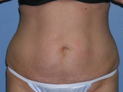 Tummy Tuck (Abdominoplasty) Before & After Gallery - Patient 6973077 - Image 1
