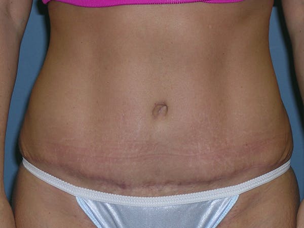 Tummy Tuck (Abdominoplasty) Before & After Gallery - Patient 6973077 - Image 2