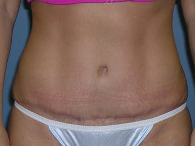Tummy Tuck (Abdominoplasty) Before & After Gallery - Patient 6973077 - Image 2