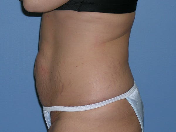 Tummy Tuck (Abdominoplasty) Before & After Gallery - Patient 6973077 - Image 3