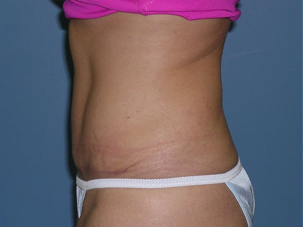 Tummy Tuck (Abdominoplasty) Before & After Gallery - Patient 6973077 - Image 4