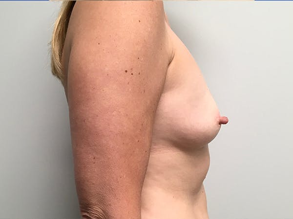 Breast Augmentation Before & After Gallery - Patient 7315984 - Image 3