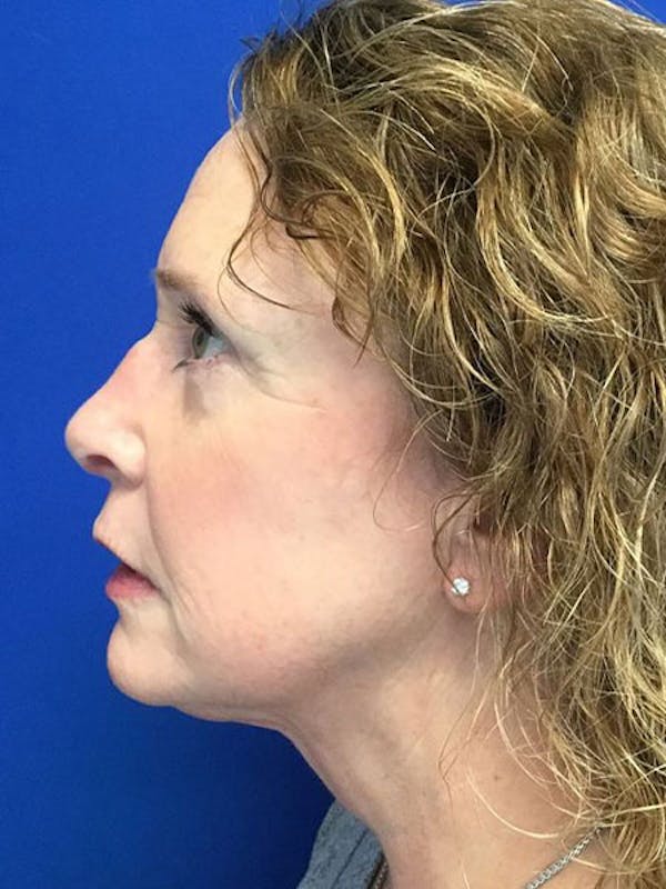Injectable Fillers Before & After Gallery - Patient 607217 - Image 4
