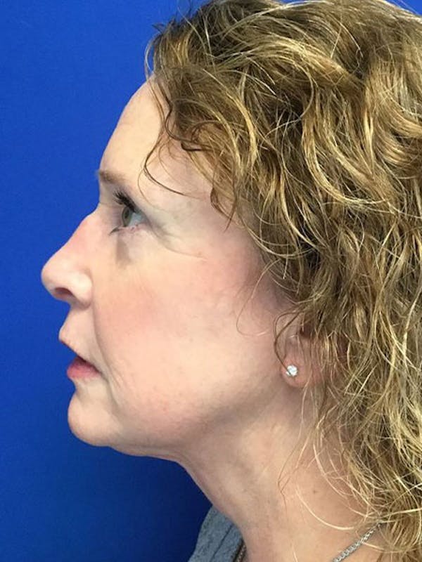 Kybella® Before & After Gallery - Patient 7461853 - Image 4