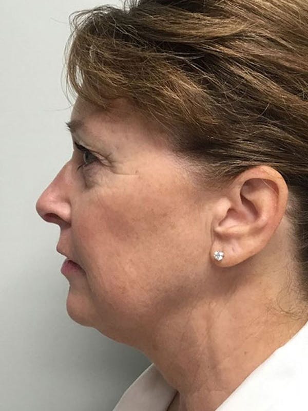 Kybella® Before & After Gallery - Patient 7461853 - Image 3