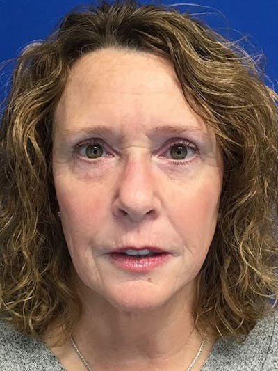 Blepharoplasty Before & After Gallery - Patient 7461841 - Image 2