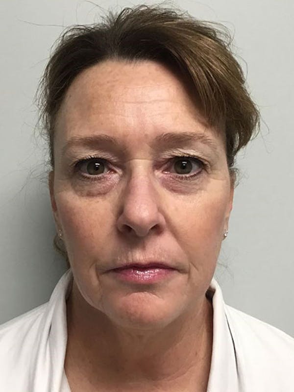 Blepharoplasty Before & After Gallery - Patient 7461841 - Image 1