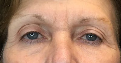 Blepharoplasty Before & After Gallery - Patient 7897782 - Image 1