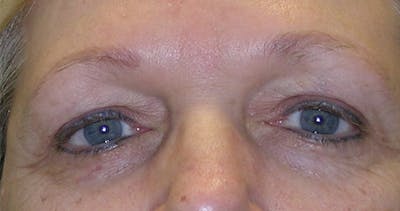 Blepharoplasty Before & After Gallery - Patient 7897783 - Image 1