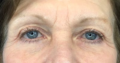 Blepharoplasty Before & After Gallery - Patient 7897782 - Image 2
