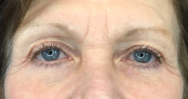 Blepharoplasty Before & After Gallery - Patient 7897782 - Image 2