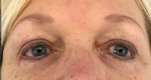 Blepharoplasty Before & After Gallery - Patient 7897783 - Image 2