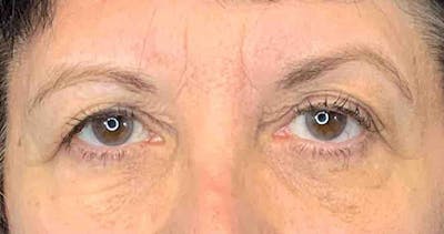 Blepharoplasty Before & After Gallery - Patient 7897784 - Image 1