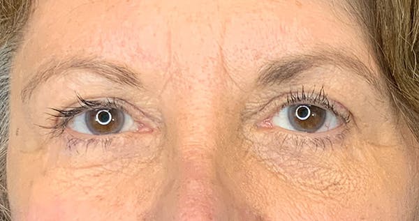 Blepharoplasty Before & After Gallery - Patient 7897784 - Image 2