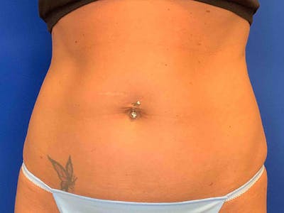 Tummy Tuck (Abdominoplasty) Before & After Gallery - Patient 7897830 - Image 1