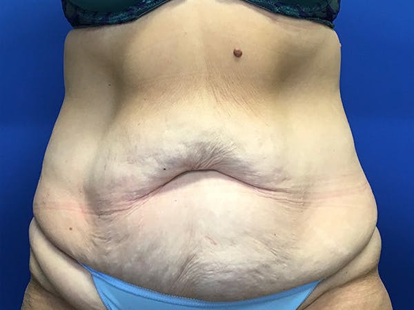 Tummy Tuck (Abdominoplasty) Before & After Gallery - Patient 7897831 - Image 1