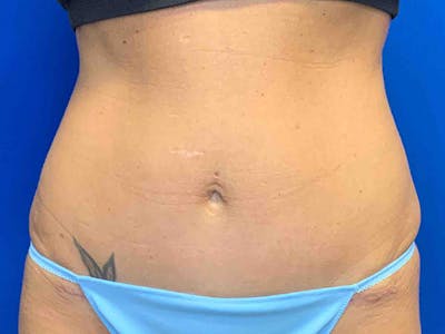Tummy Tuck (Abdominoplasty) Before & After Gallery - Patient 7897830 - Image 2