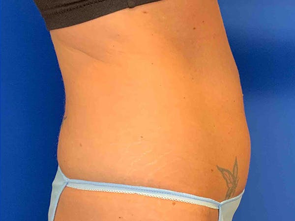Tummy Tuck (Abdominoplasty) Before & After Gallery - Patient 7897830 - Image 3