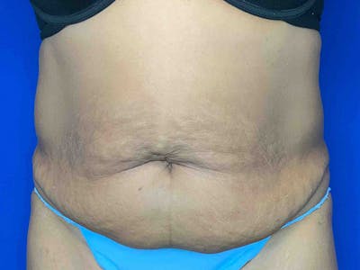 Tummy Tuck (Abdominoplasty) Before & After Gallery - Patient 7897832 - Image 1