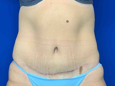 Tummy Tuck (Abdominoplasty) Before & After Gallery - Patient 7897831 - Image 2
