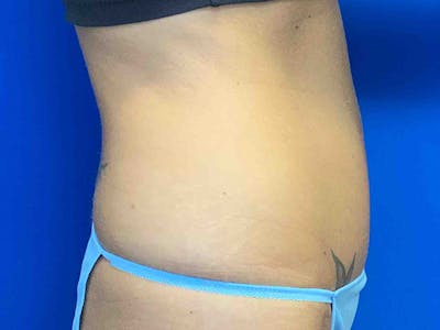 Tummy Tuck (Abdominoplasty) Before & After Gallery - Patient 7897830 - Image 4