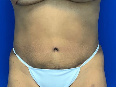 Tummy Tuck (Abdominoplasty) Gallery - Patient 7897832 - Image 2