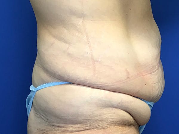Tummy Tuck (Abdominoplasty) Before & After Gallery - Patient 7897831 - Image 3