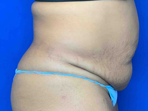 Tummy Tuck (Abdominoplasty) Before & After Gallery - Patient 7897832 - Image 3