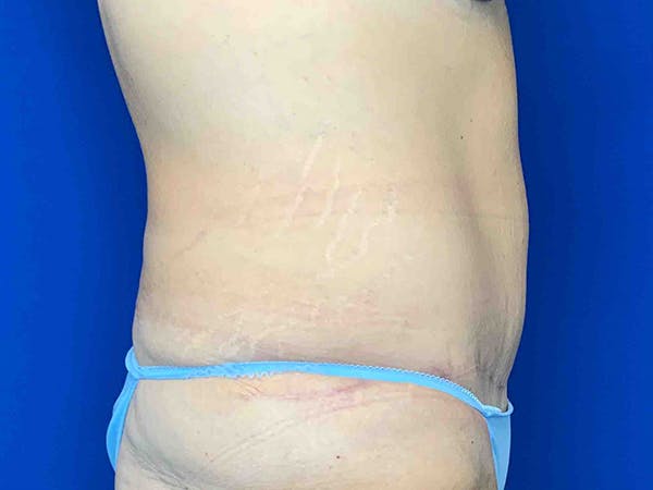 Tummy Tuck (Abdominoplasty) Gallery - Patient 7897831 - Image 4