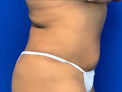 Liposuction Before & After Gallery - Patient 7897840 - Image 4