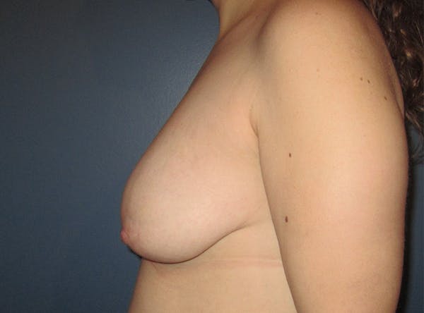 Breast Implant Reconstruction Before & After Gallery - Patient 8012494 - Image 5