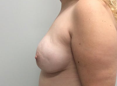 Breast Implant Reconstruction Before & After Gallery - Patient 8012494 - Image 6