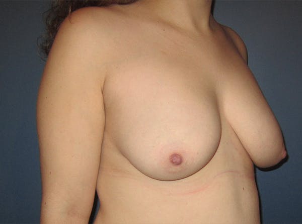 Breast Implant Reconstruction Before & After Gallery - Patient 8012494 - Image 7