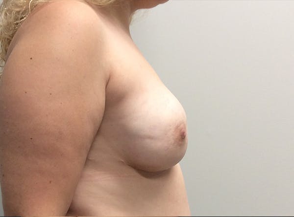 Breast Implant Reconstruction Before & After Gallery - Patient 8012494 - Image 10