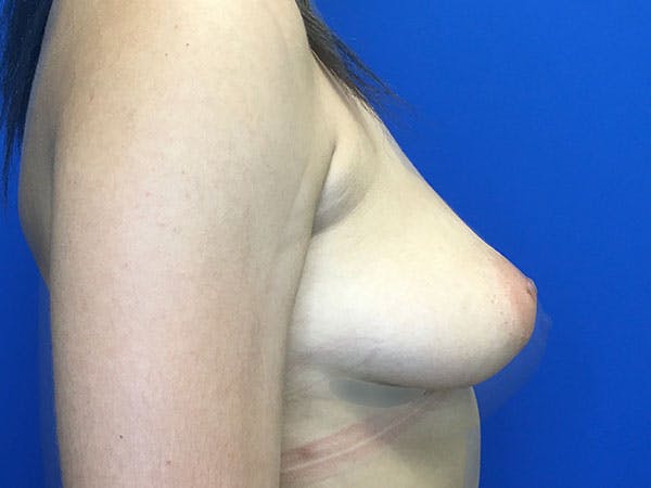Breast Augmentation Before & After Gallery - Patient 8059691 - Image 7