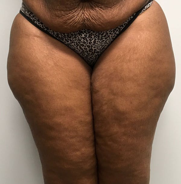 Mommy Makeover Before & After Gallery - Patient 8341555 - Image 5