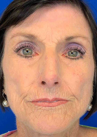 Laser Skin Resurfacing Before & After Gallery - Patient 8375930 - Image 2