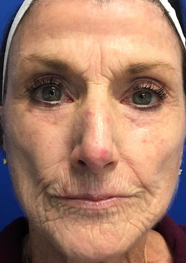 Laser Skin Resurfacing Before & After Gallery - Patient 8375930 - Image 1