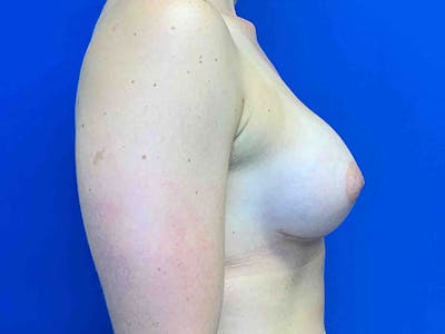 Breast Augmentation Before & After Gallery - Patient 8375932 - Image 4