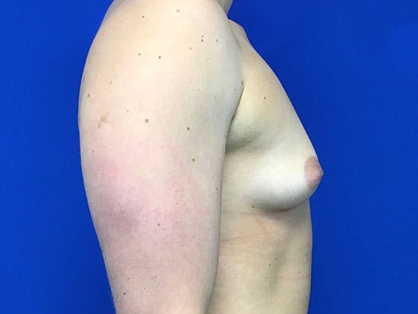 Breast Augmentation Before & After Gallery - Patient 8375932 - Image 3