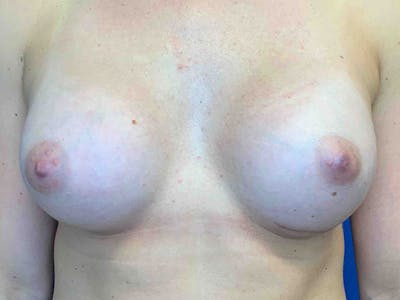Breast Augmentation Before & After Gallery - Patient 8375932 - Image 2