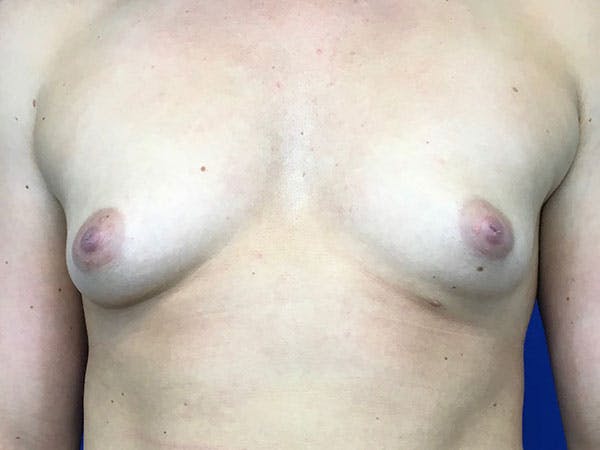 Breast Augmentation Gallery - Patient 8375932 - Image 1