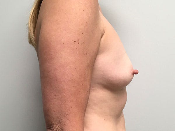 Breast Augmentation Before & After Gallery - Patient 8375938 - Image 3
