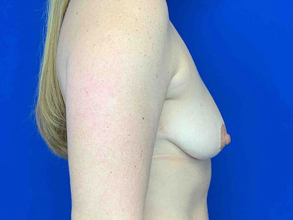 Breast Augmentation Before & After Gallery - Patient 8375941 - Image 3